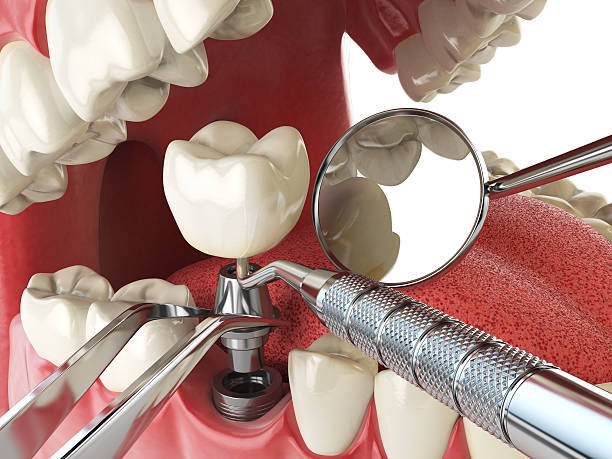 Best Emergency Broken Tooth Repair in Muttontown, NY